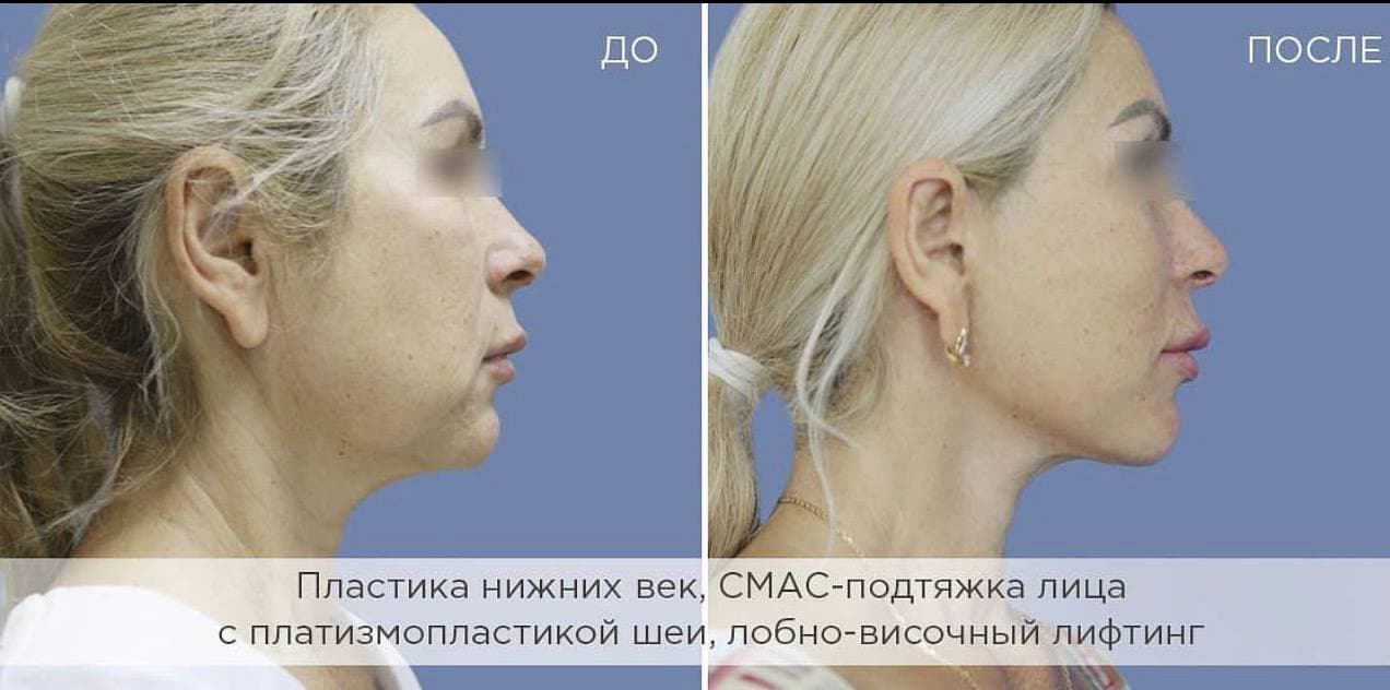 Фейслифтинг
